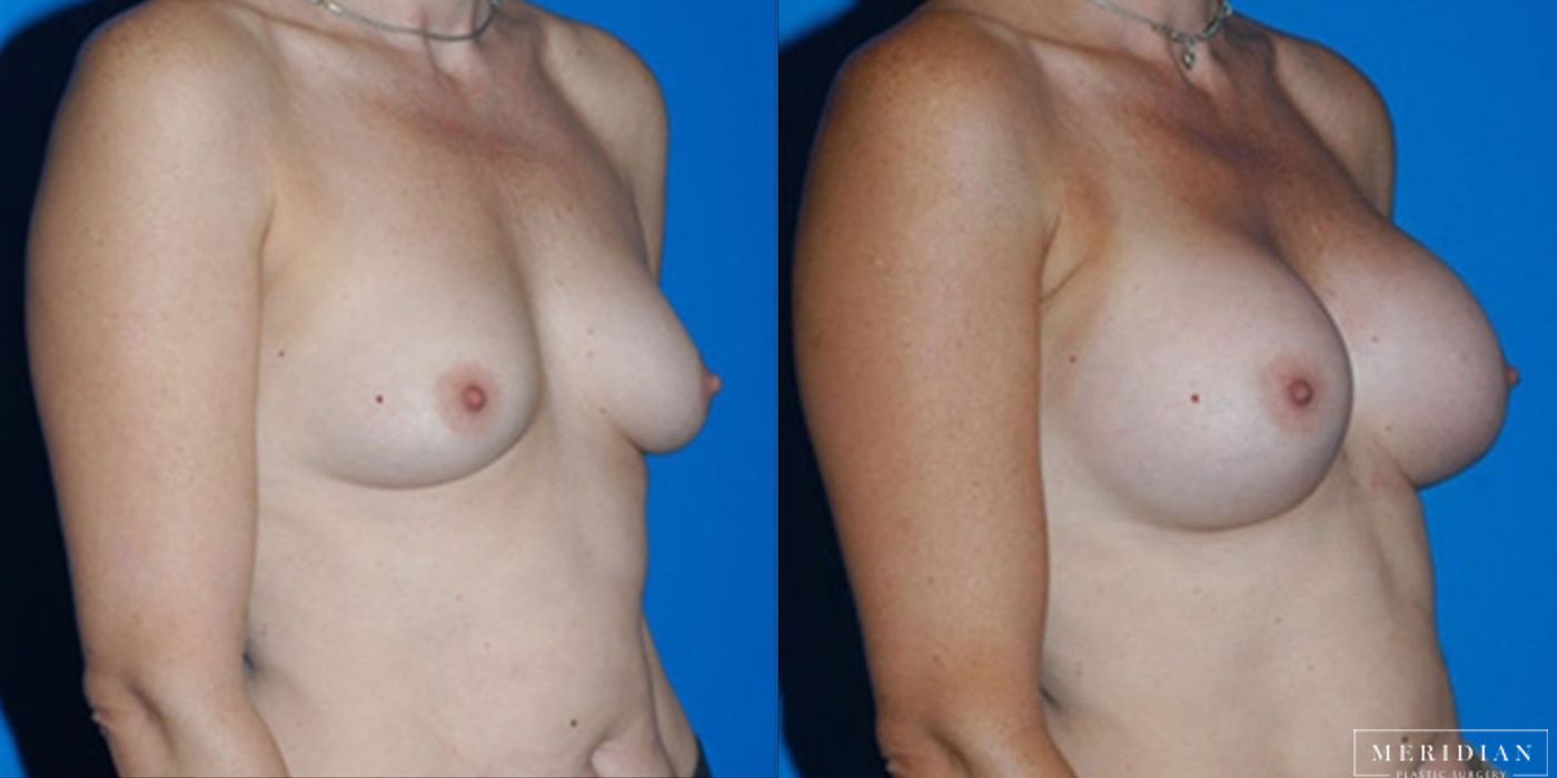 Breast Augmentation - Thumbnail 2