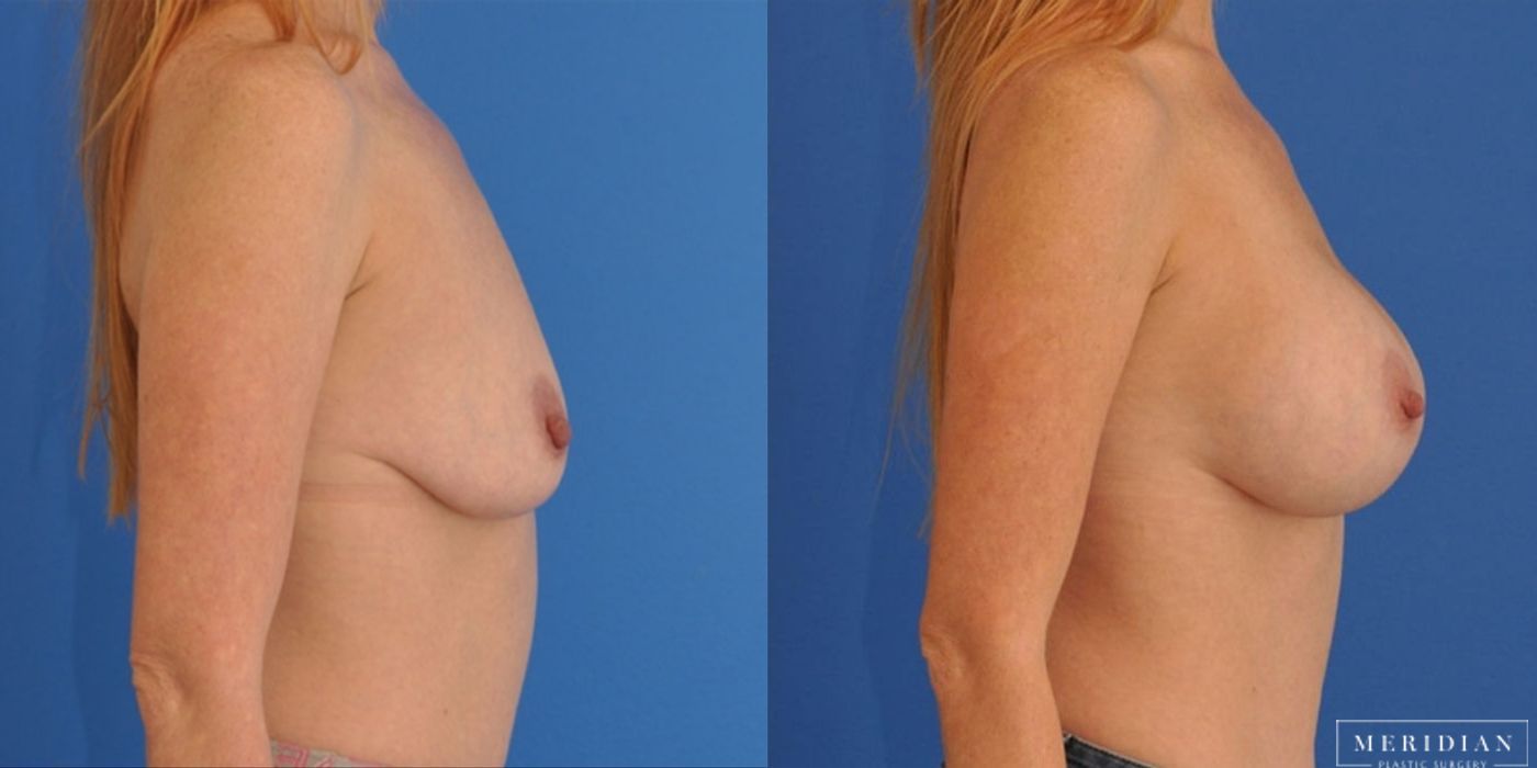 Breast Augmentation - Case 8525