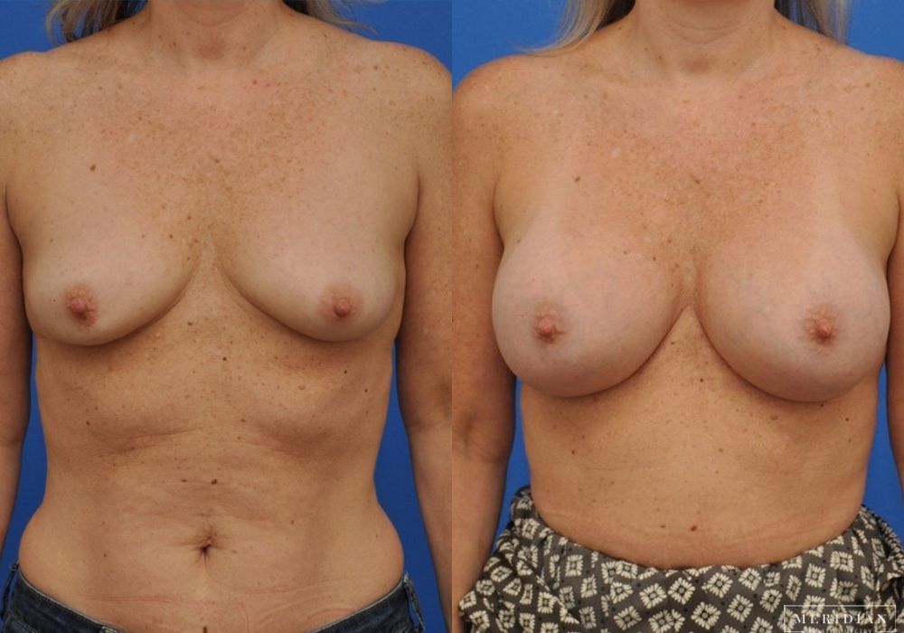 Breast Augmentation - Case 8045