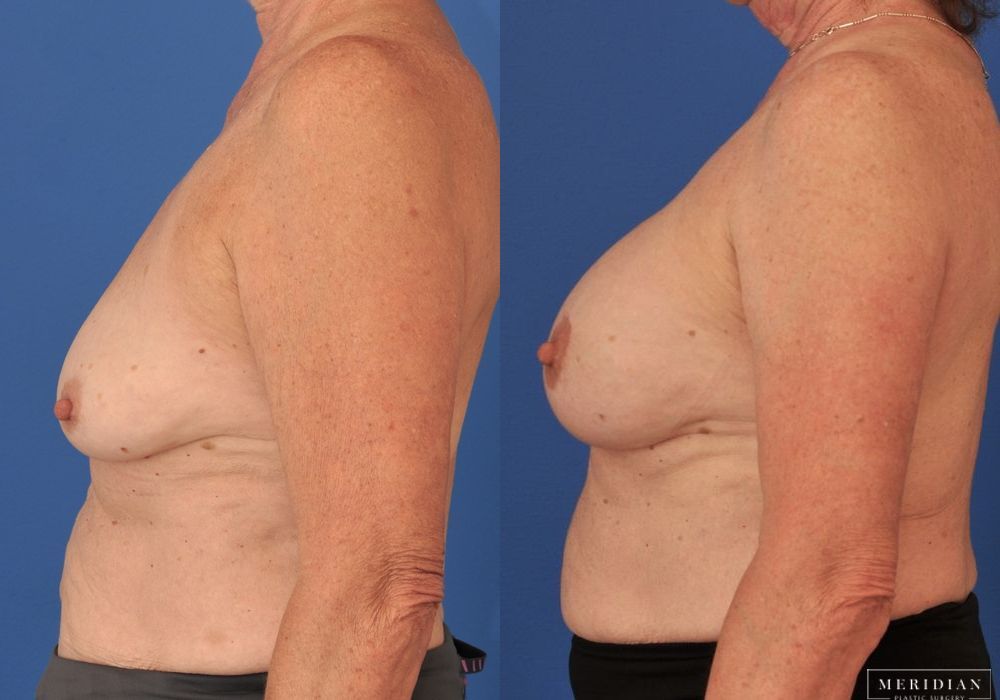 Breast Augmentation - Thumbnail 3