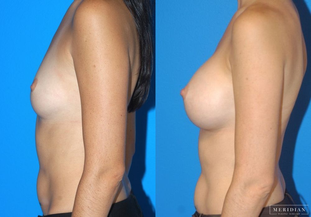 Breast Augmentation - Thumbnail 2