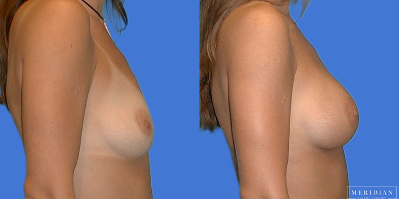 Breast Augmentation - Thumbnail 3