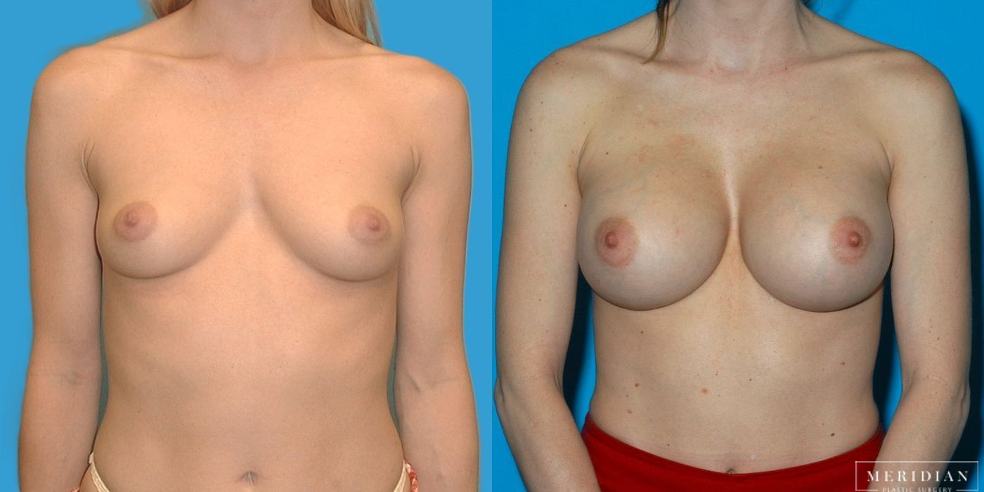 Breast Augmentation - Thumbnail 2