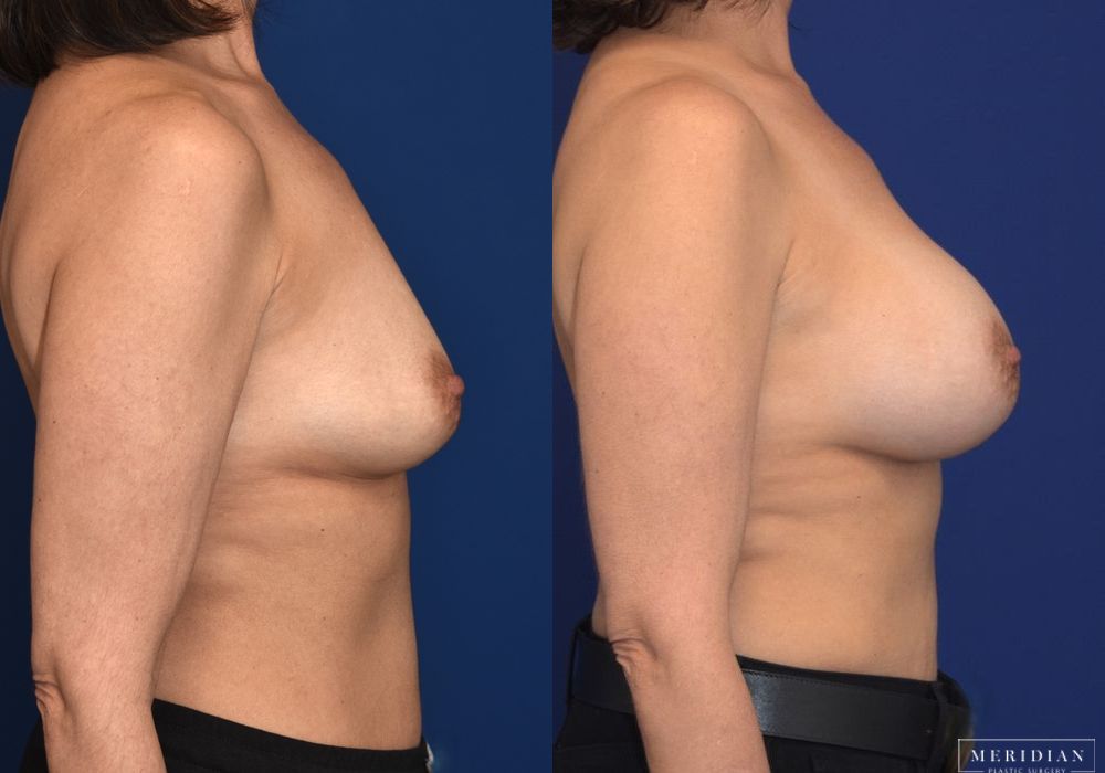 Breast Augmentation - Thumbnail 3