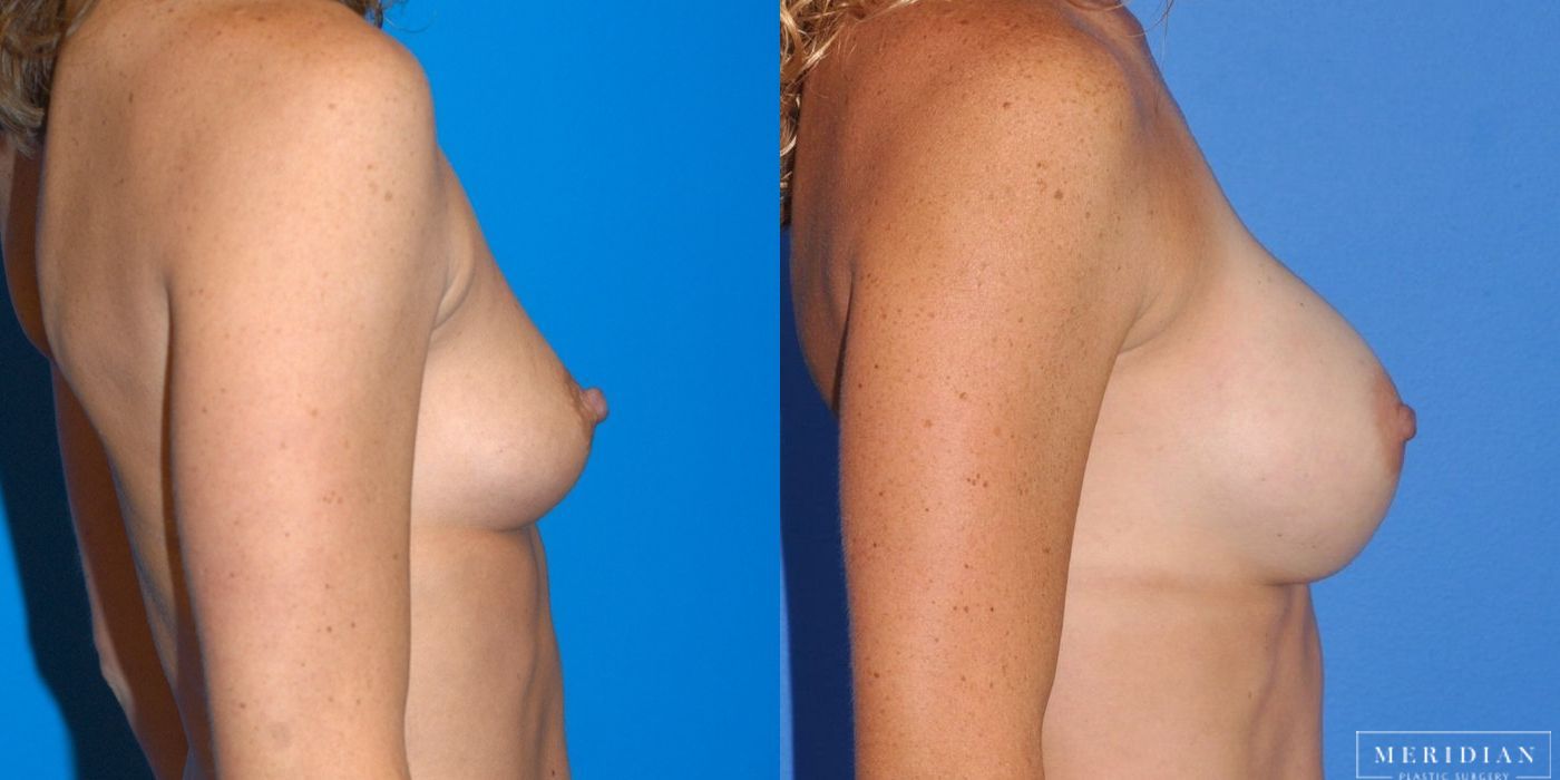 Breast Augmentation - Thumbnail 3