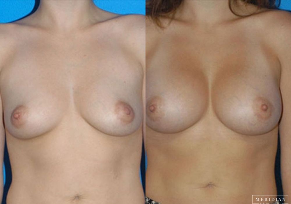 Breast Augmentation - Case 8040