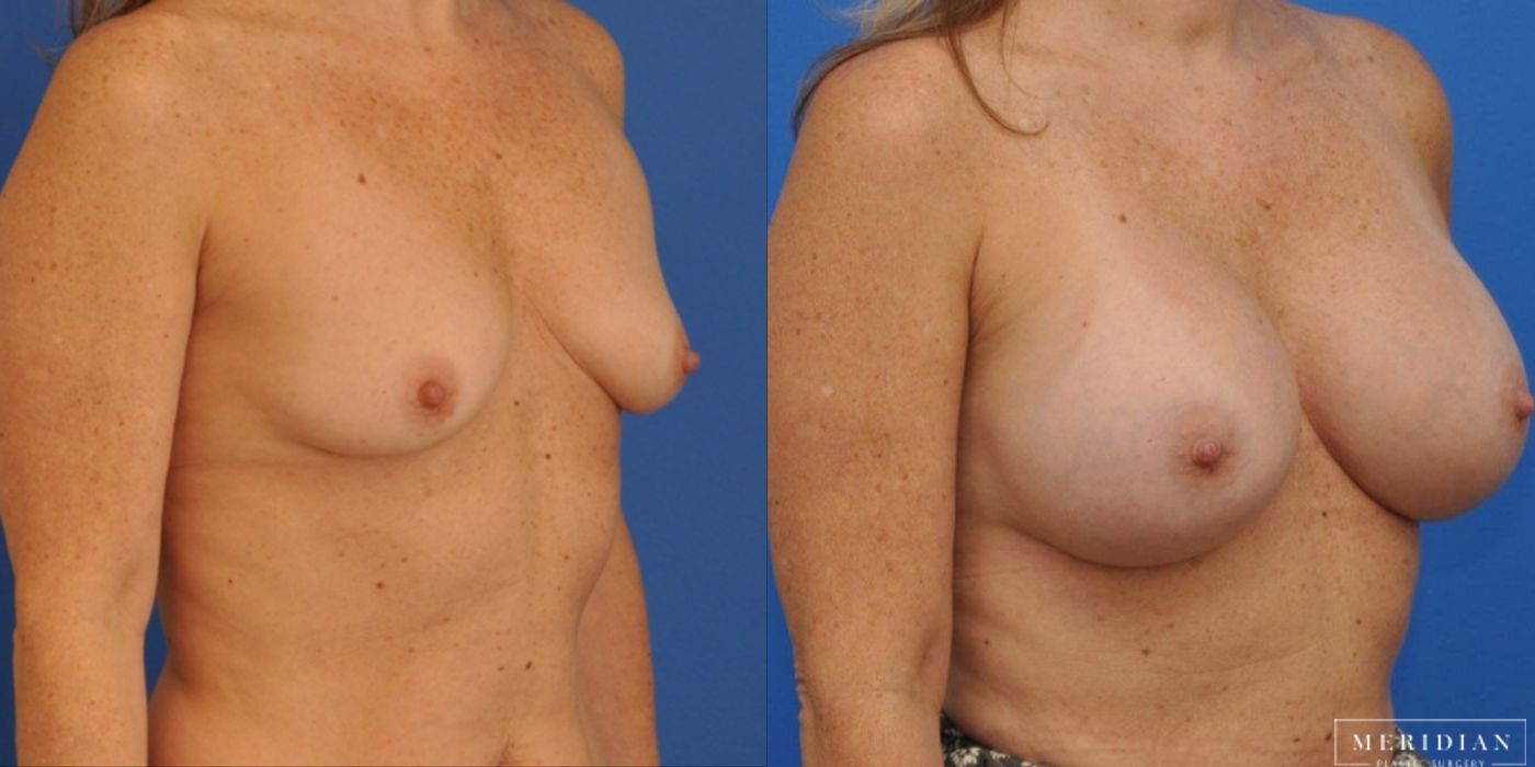 Breast Augmentation - Thumbnail 2