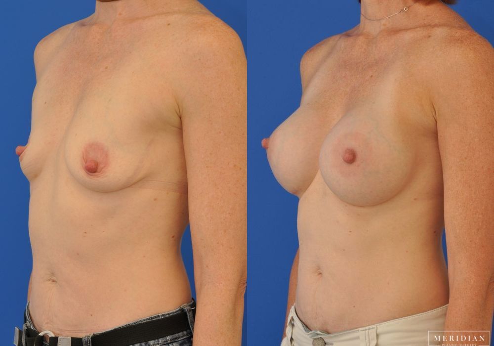 Breast Augmentation - Thumbnail 2