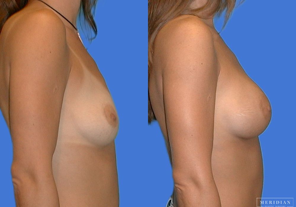 Breast Augmentation - Thumbnail 3