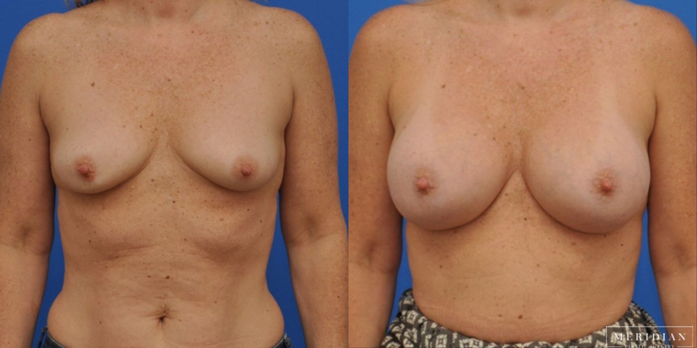 Breast Augmentation - Case 8528