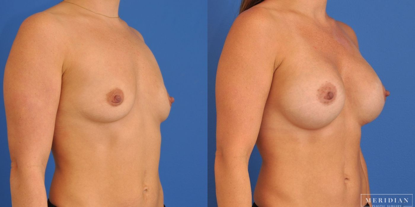 Breast Augmentation - Thumbnail 2