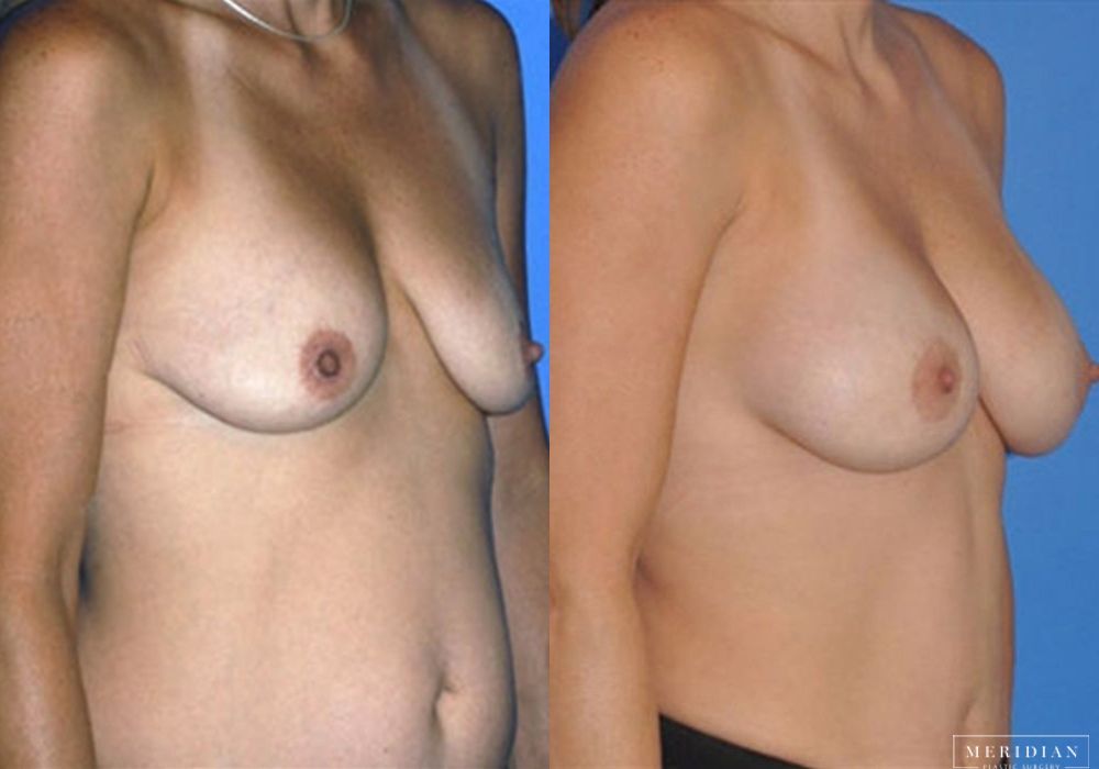 Breast Lift - Thumbnail 2