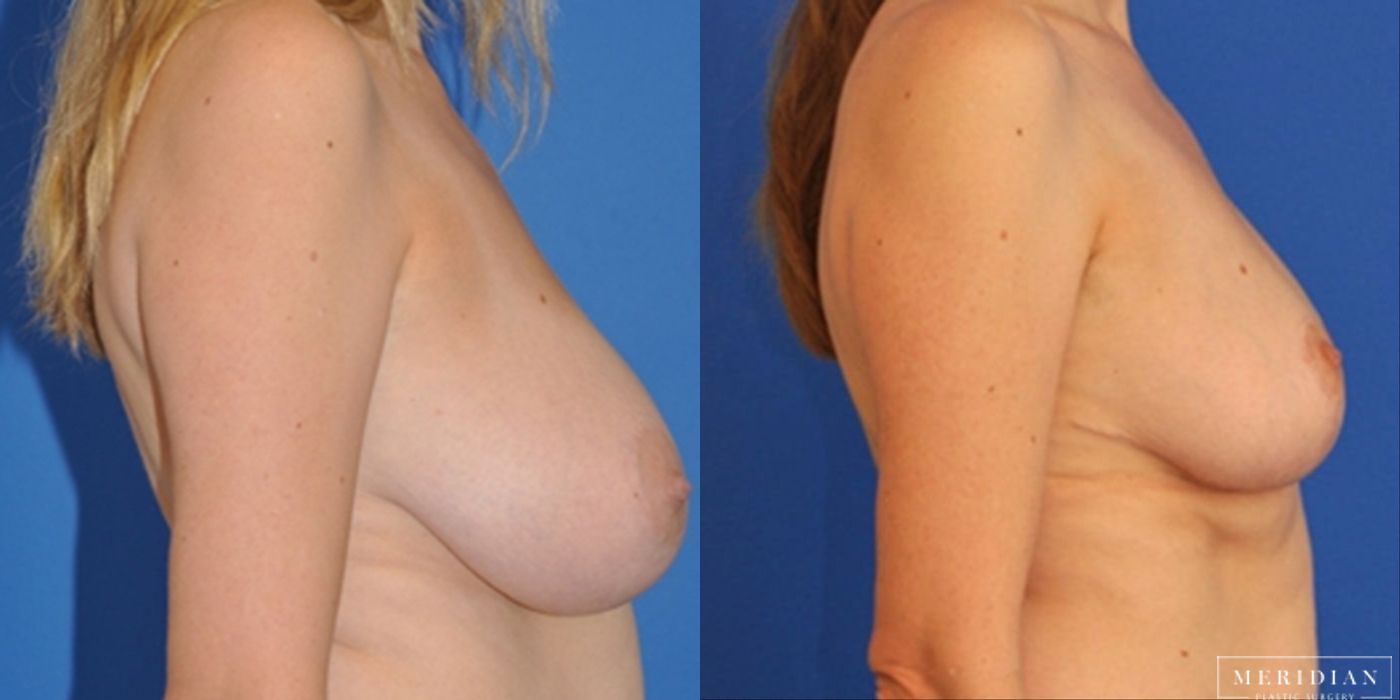 Breast Lift - Thumbnail 2