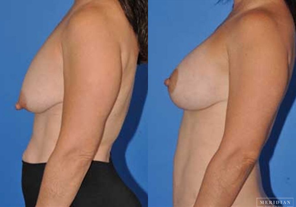 Breast Lift - Thumbnail 2