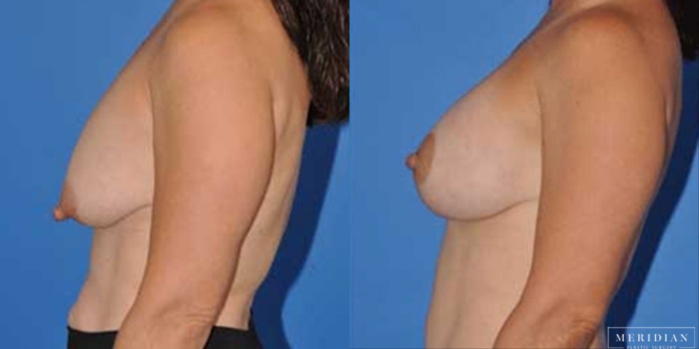 Breast Lift - Thumbnail 2