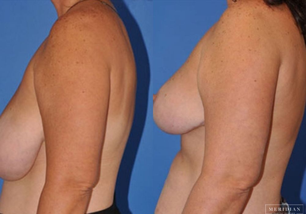 Breast Lift - Thumbnail 2