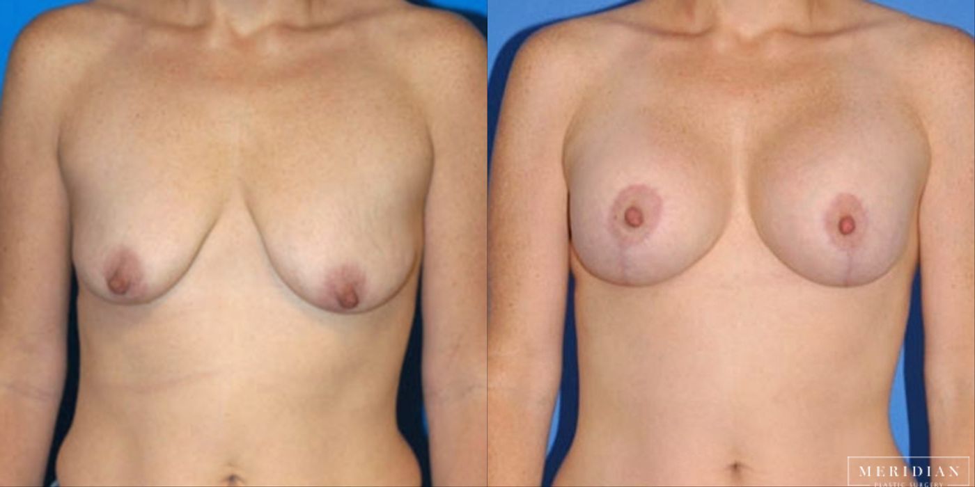 Breast Lift - Case 8551