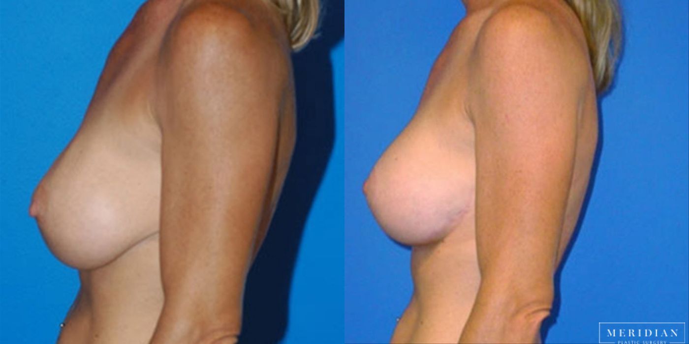 Breast Lift - Thumbnail 2