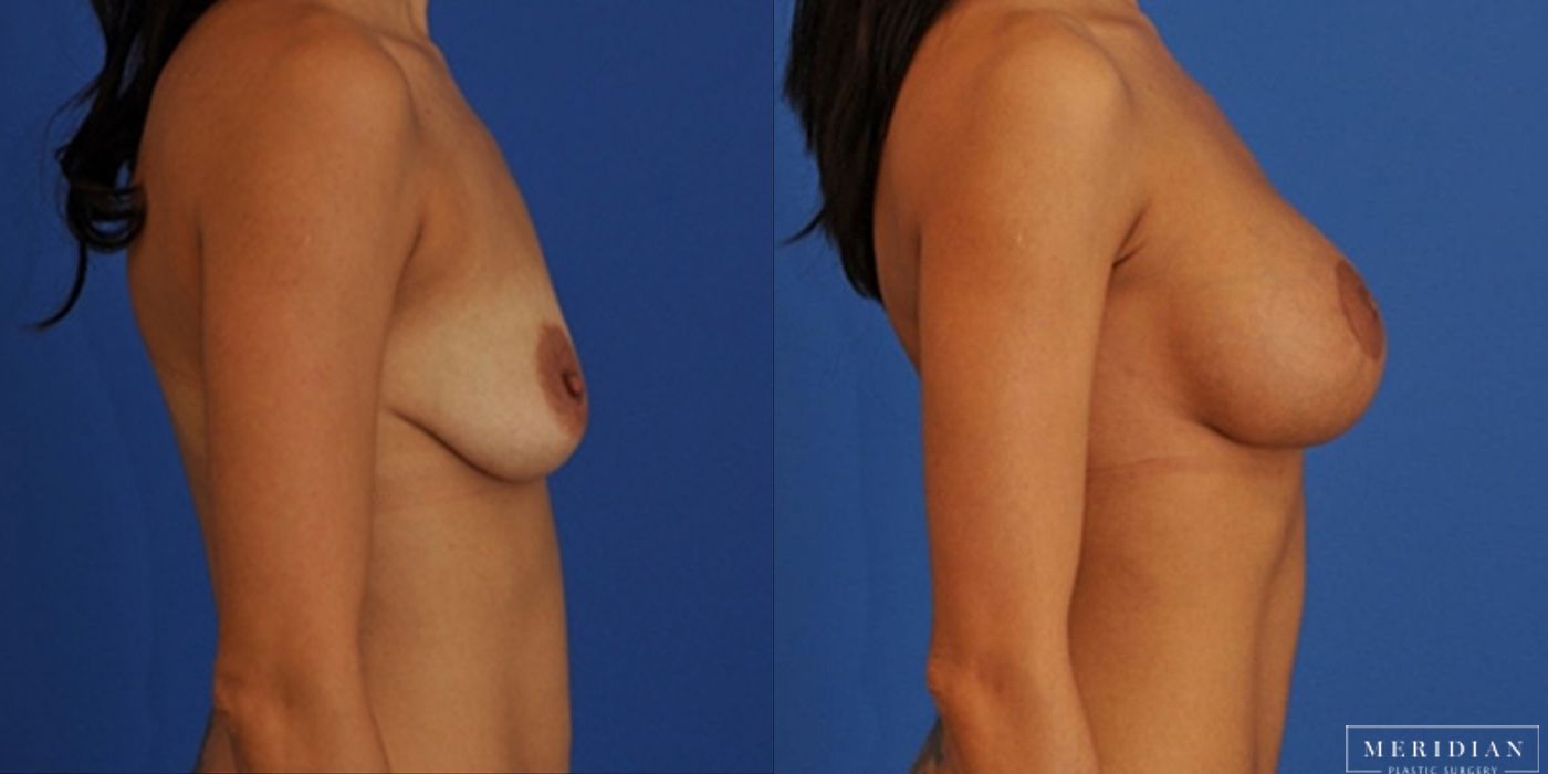 Breast Lift - Thumbnail 2