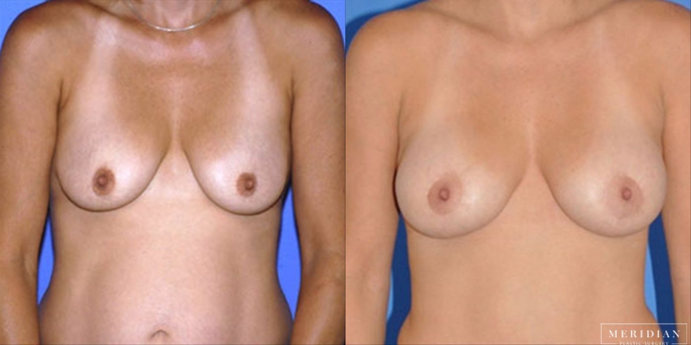 Breast Lift - Case 8544