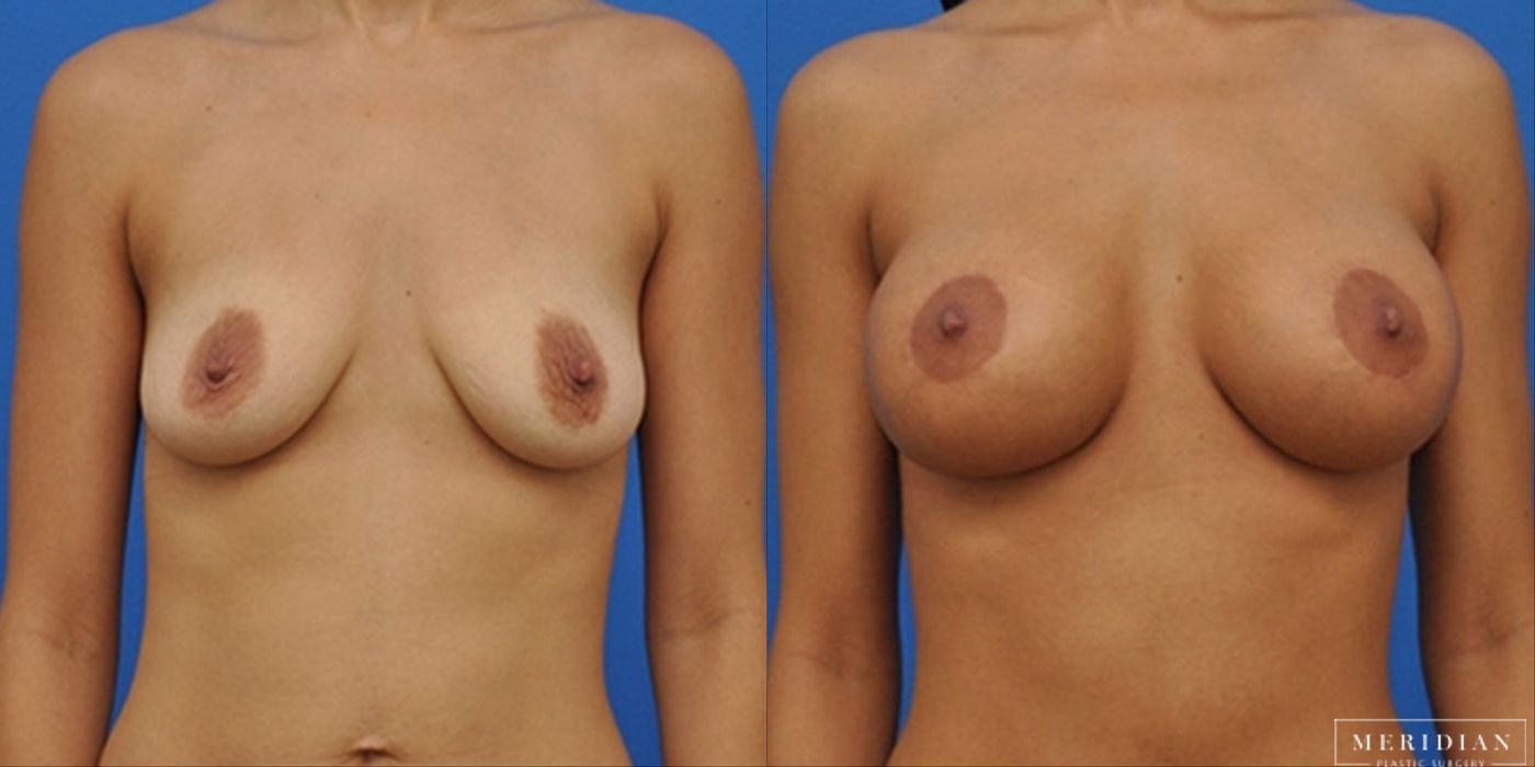 Breast Lift - Case 8555