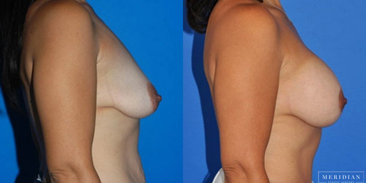 Breast Lift - Case 8547