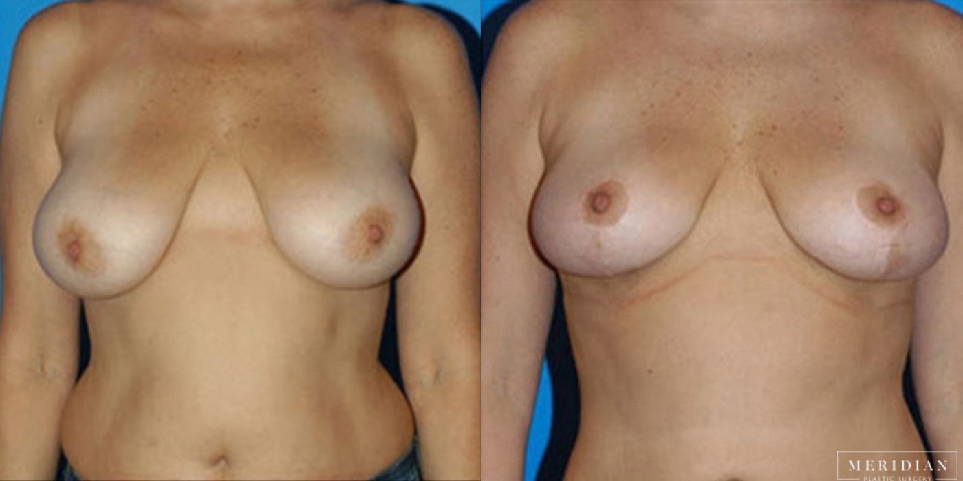 Breast Lift - Case 8542