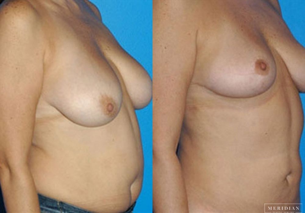 Breast Lift - Thumbnail 2