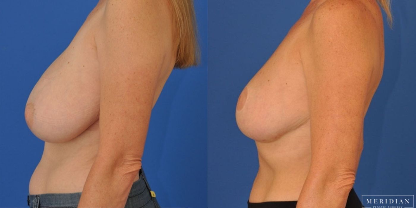 Breast Lift - Thumbnail 2