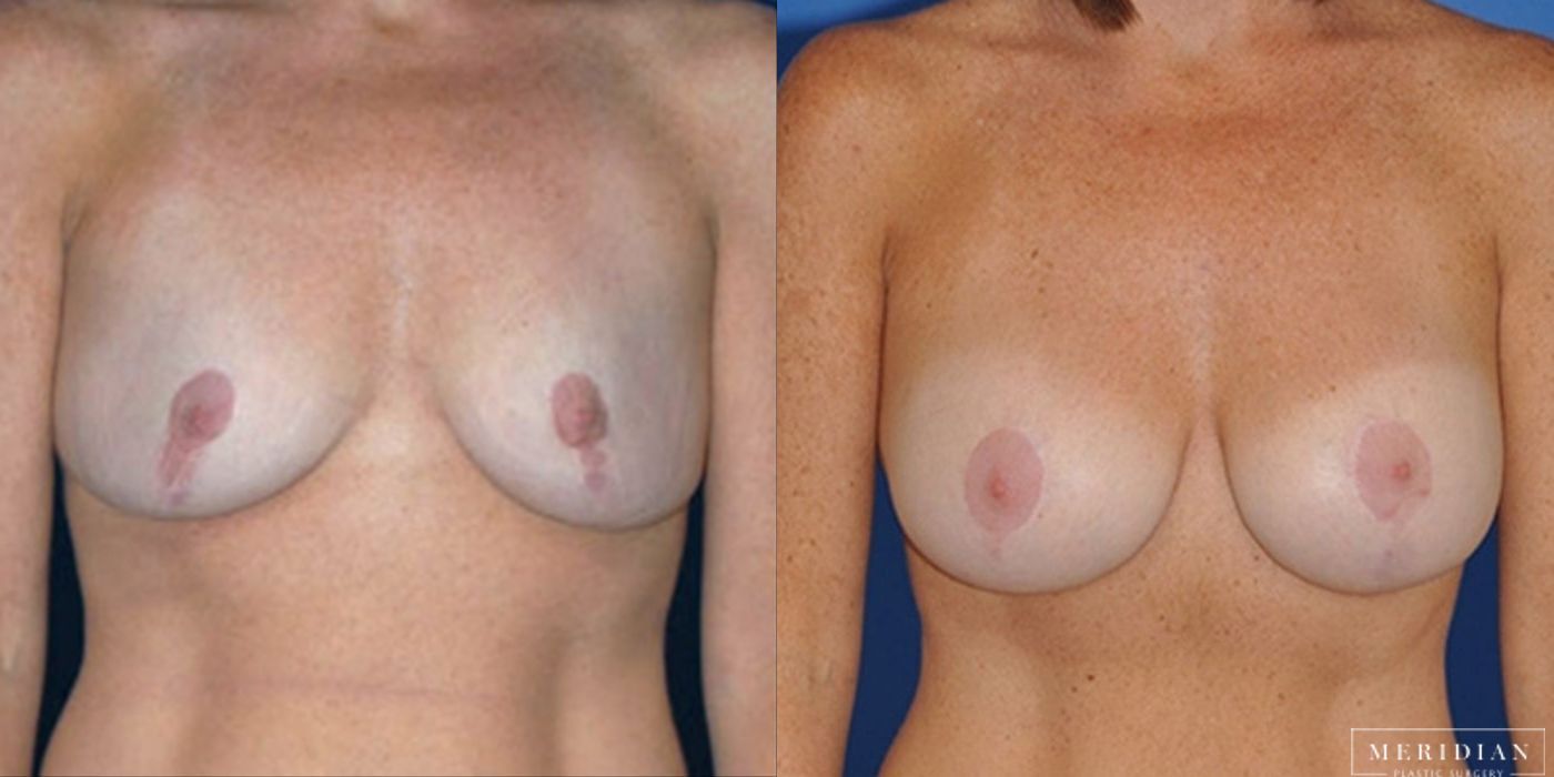 Breast Lift - Case 8546