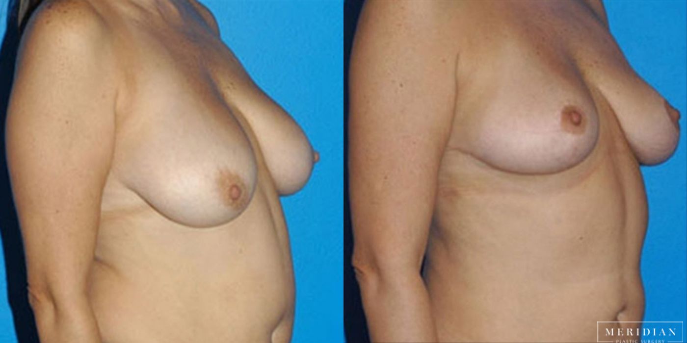 Breast Lift - Thumbnail 2