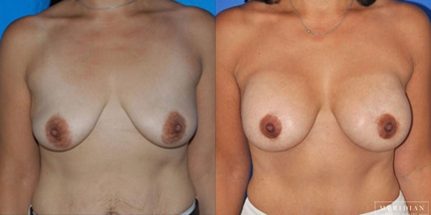 Breast Lift - Thumbnail 2