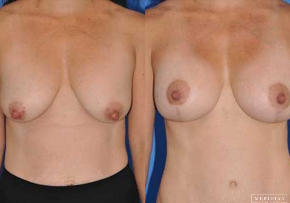 Breast Lift - Case 7867