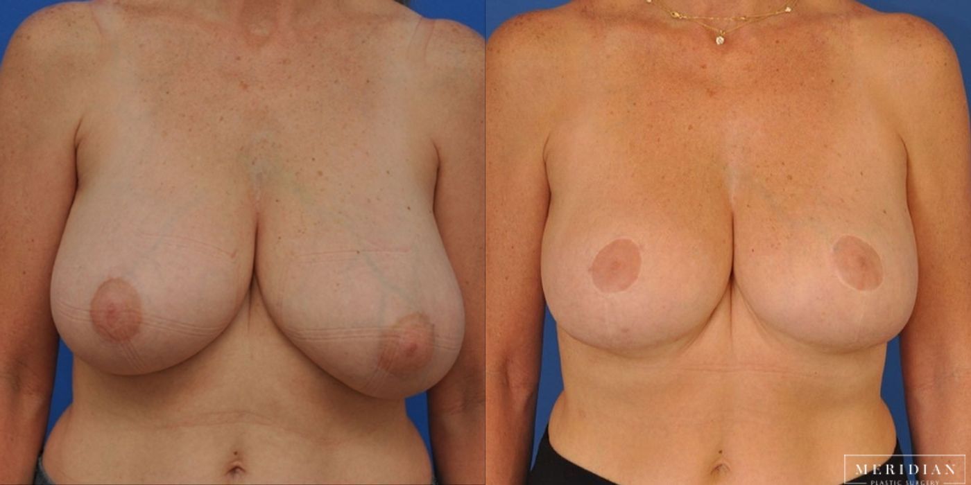 Breast Lift - Case 8554