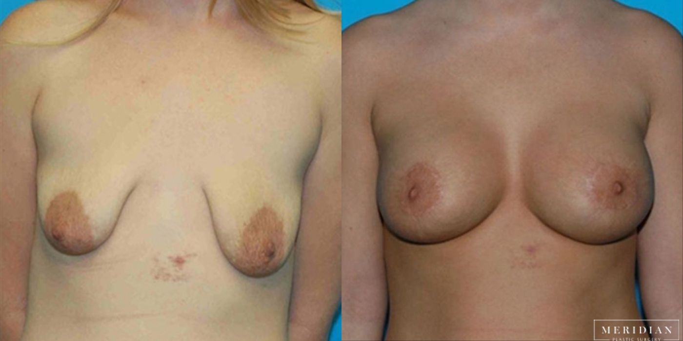 Breast Lift - Case 8548