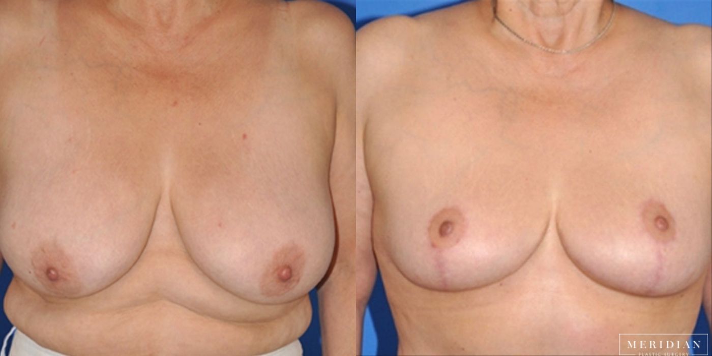 Breast Lift - Case 8553