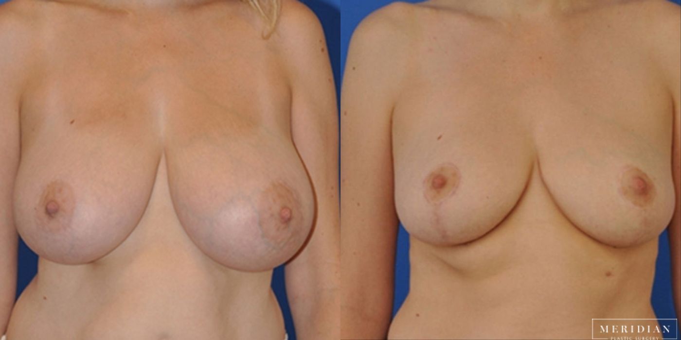 Breast Lift - Case 8549