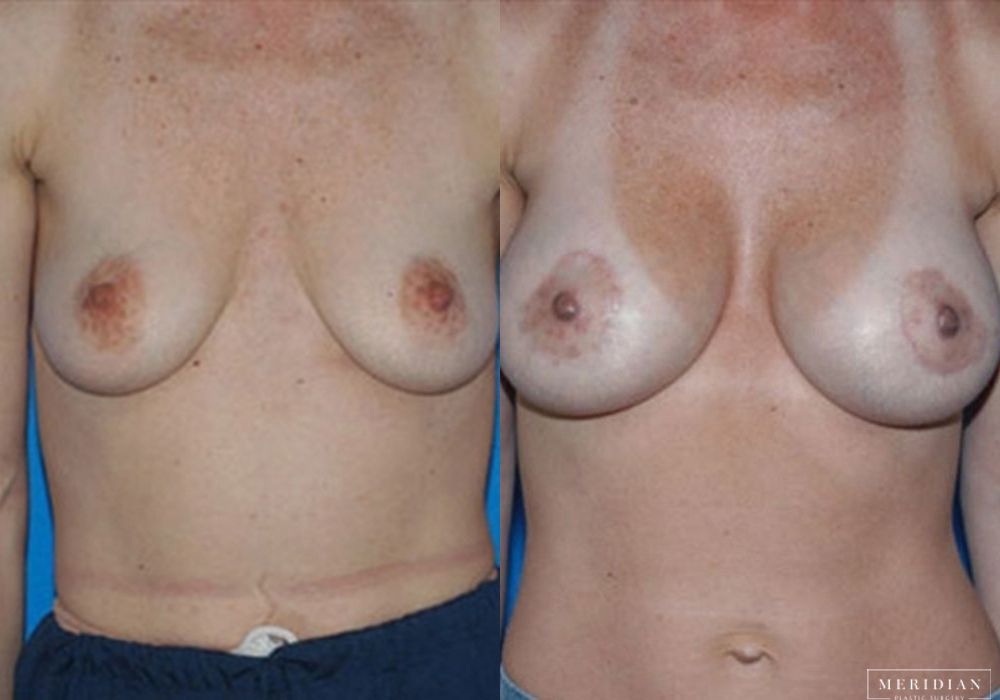 Breast Lift - Case 7872