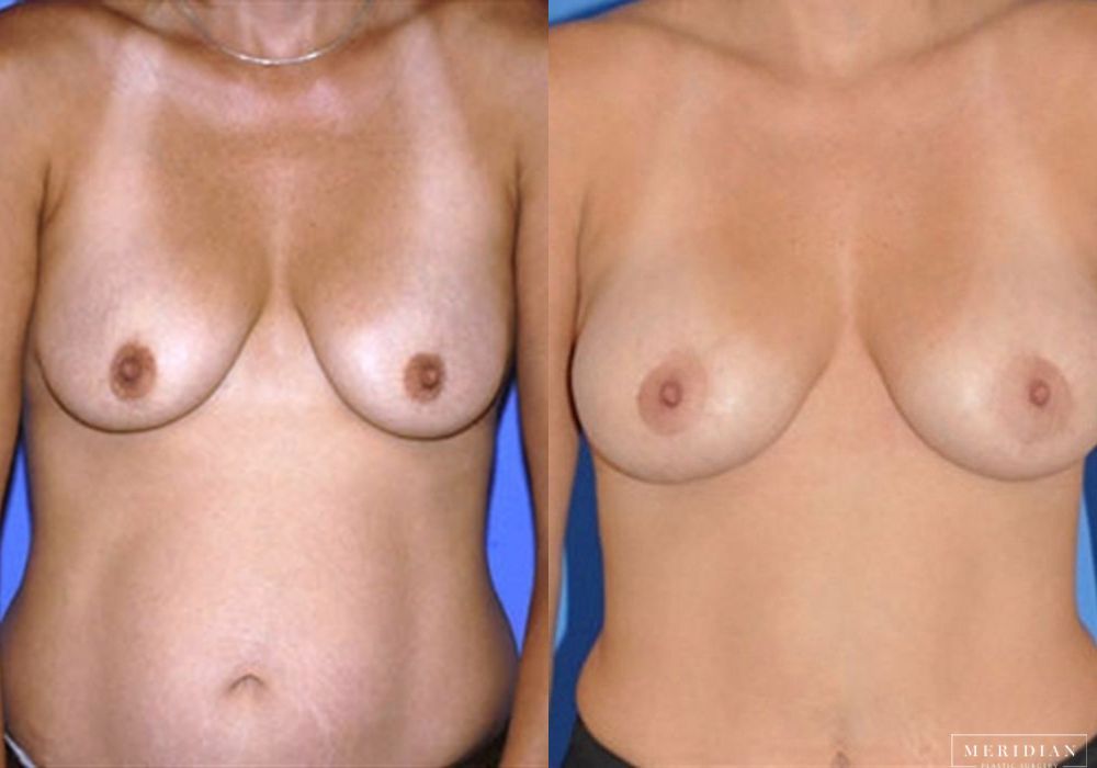 Breast Lift - Case 7866