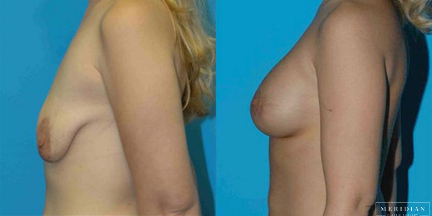 Breast Lift - Thumbnail 2