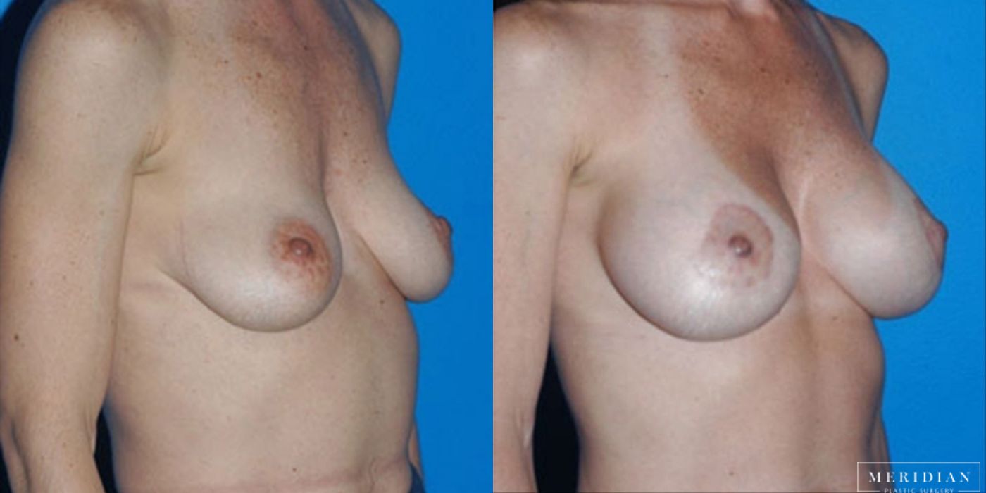 Breast Lift - Thumbnail 2