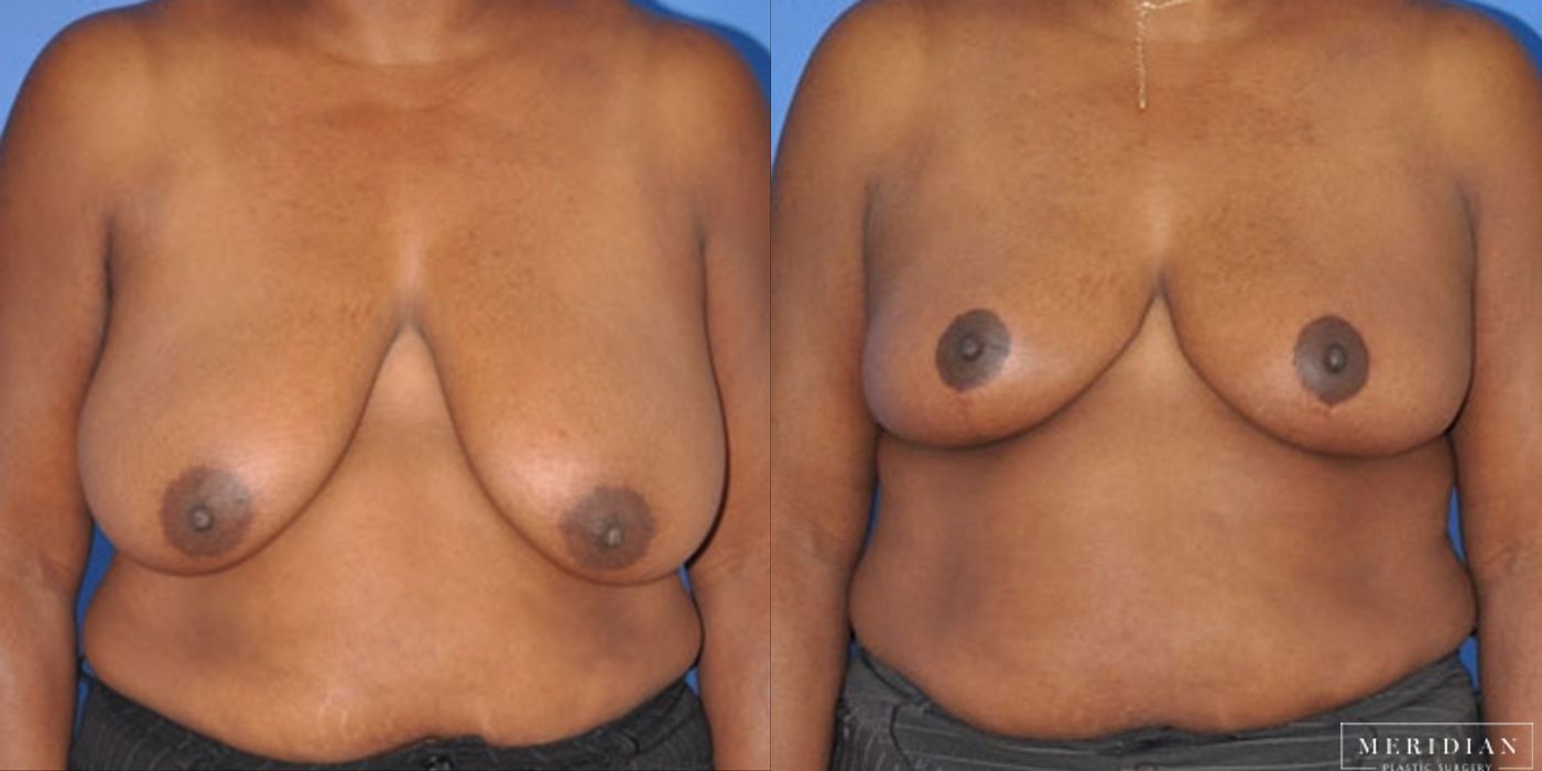 Breast Lift - Case 8543