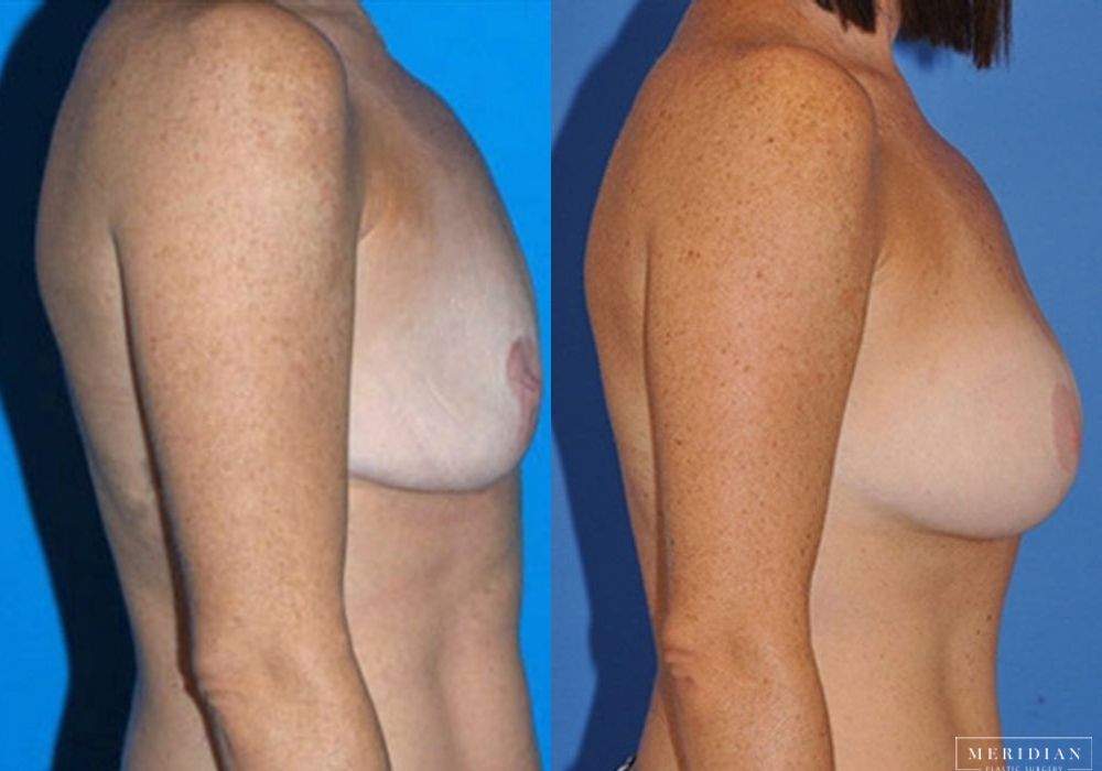 Breast Lift - Thumbnail 2