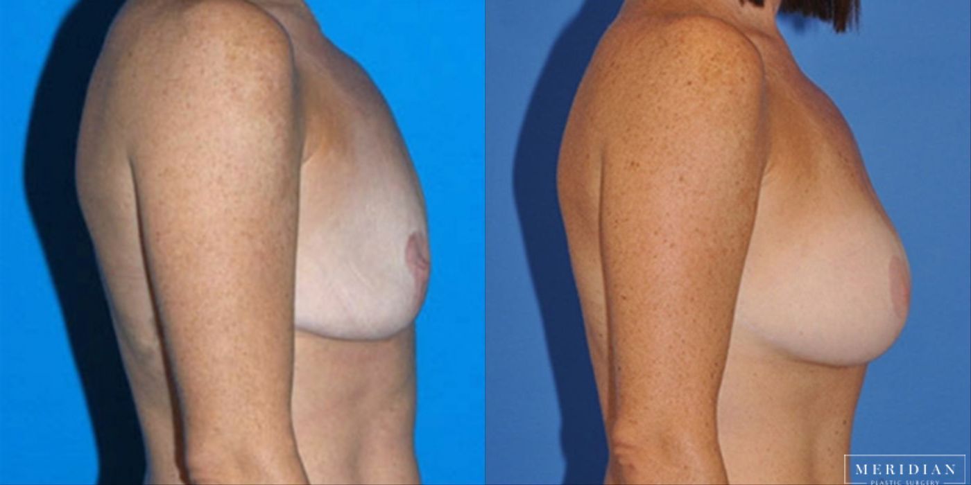 Breast Lift - Thumbnail 2