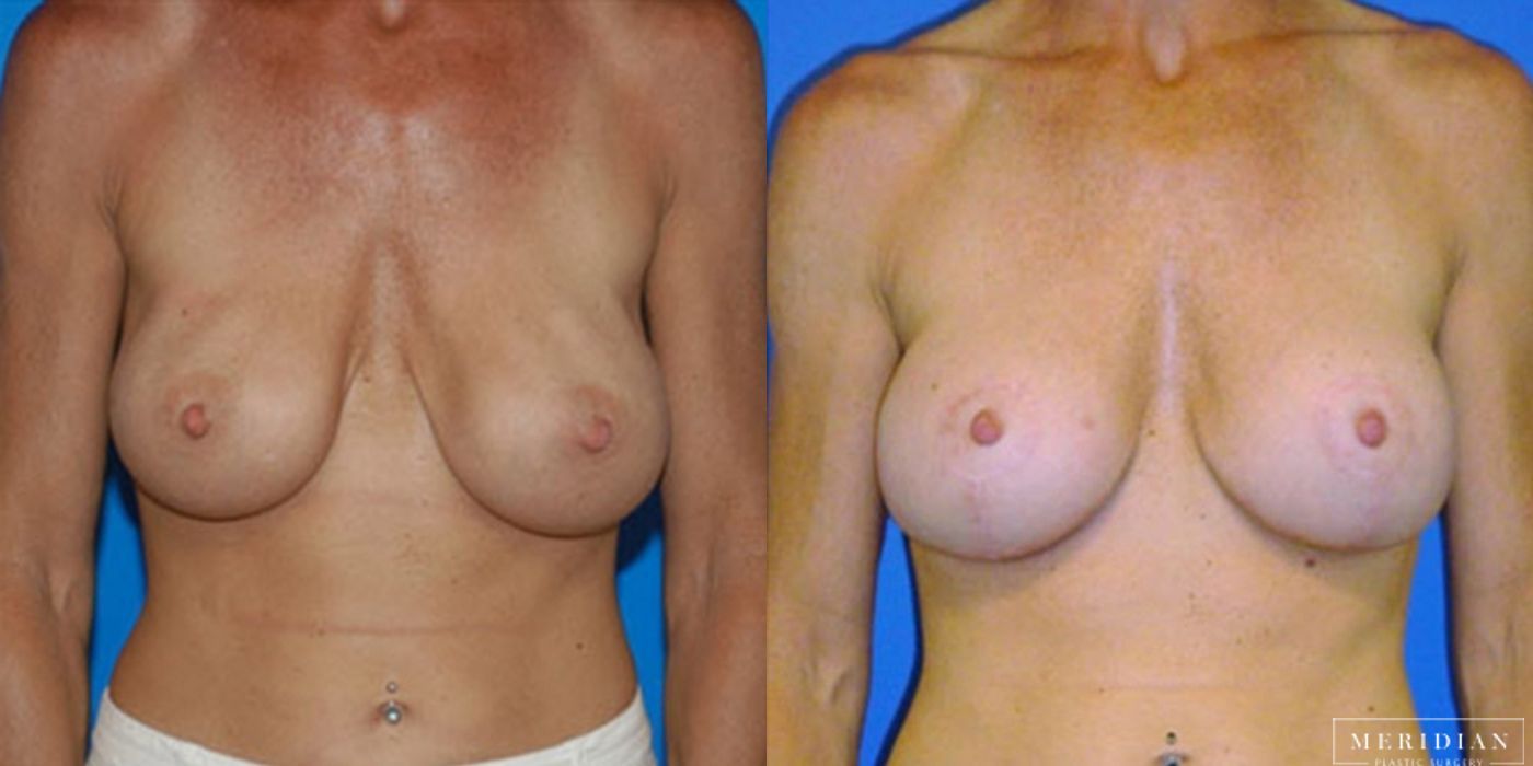 Breast Lift - Case 8552
