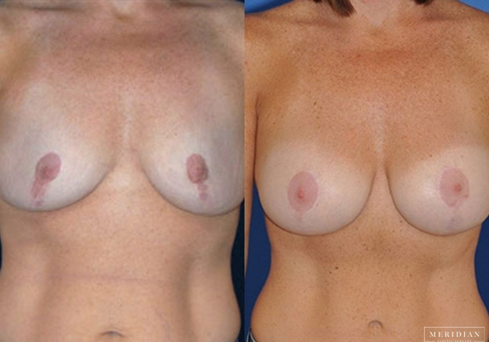 Breast Lift - Case 7868