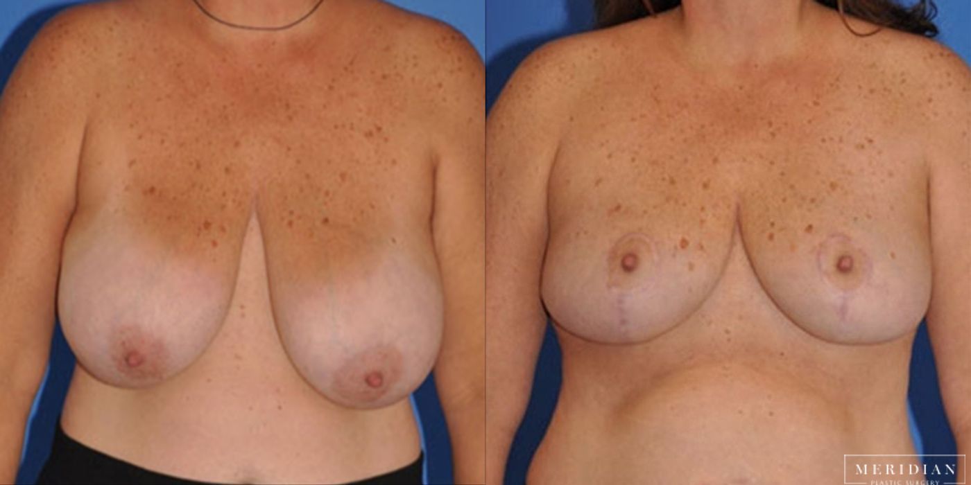 Breast Lift - Thumbnail 2