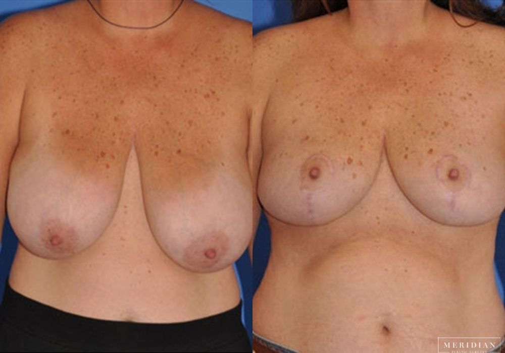 Breast Lift - Case 7862