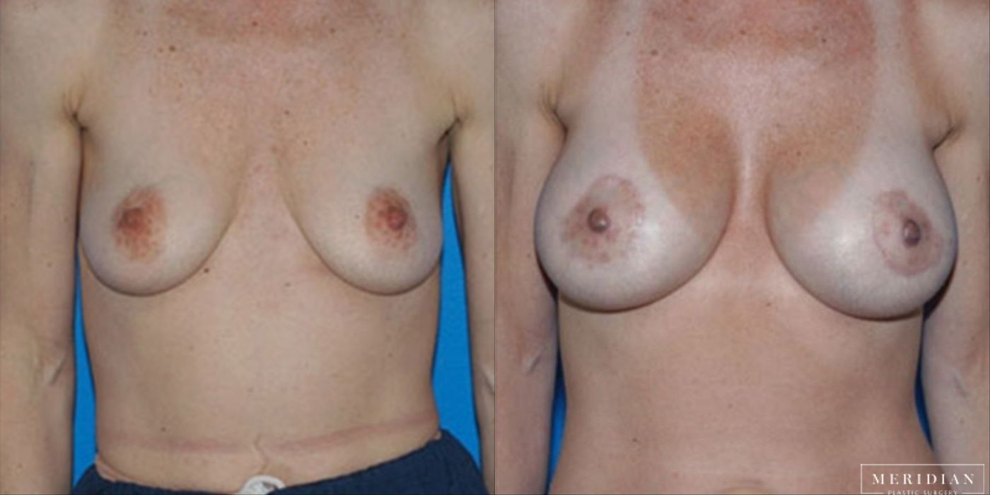 Breast Lift - Case 8556
