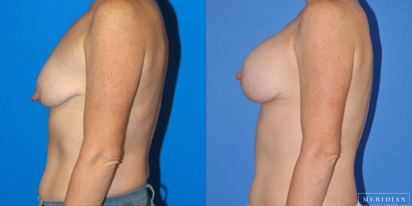 Breast Lift - Thumbnail 2